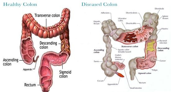 colon hydrotherapy devices